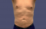 Liposuction 5 - Abdomen and Posterior Flanks After